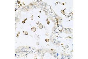 Immunohistochemistry of paraffin-embedded human gastric cancer using AIF1 antibody (ABIN5970719) at dilution of 1/100 (40x lens). (Iba1 Antikörper)