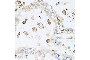 Immunohistochemistry of paraffin-embedded human gastric cancer using AIF1 antibody (ABIN5970719) at dilution of 1/100 (40x lens). (Iba1 Antikörper)