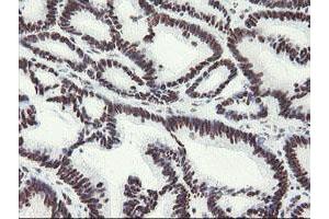 Immunohistochemical staining of paraffin-embedded Adenocarcinoma of Human colon tissue using anti-MLF1 mouse monoclonal antibody. (MLF1 Antikörper)
