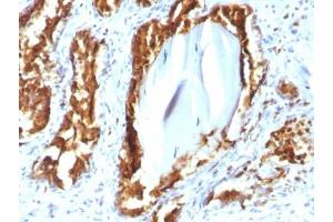 IHC testing of human prostate carcinoma with recombinant PSAP antibody (clone rACPP/1338). (Prosaposin Antikörper)