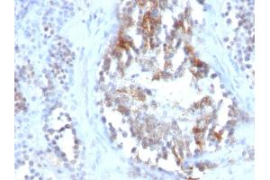 Formalin-fixed, paraffin-embedded human Testicular Carcinoma stained with SHBG Monoclonal Antibody (SPM605) (SHBG Antikörper)