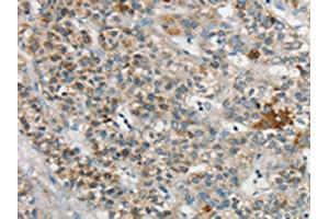 The image on the left is immunohistochemistry of paraffin-embedded Human liver cancer tissue using ABIN7192710(SYCP3 Antibody) at dilution 1/20, on the right is treated with synthetic peptide. (SYCP3 Antikörper)