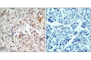 Immunohistochemistry analysis of paraffin-embedded human breast carcinoma tissue, using HER2 (Ab-1221/1222) Antibody. (ErbB2/Her2 Antikörper  (AA 1191-1240))