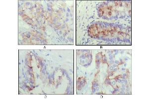 Immunohistochemical analysis of paraffin-embedded human lung cancer (A), recturn(B), prostate (C), colon cancer (D) showing cytoplasmic localization using IGFBP2 mouse mAb with DAB staining. (IGFBP2 Antikörper)