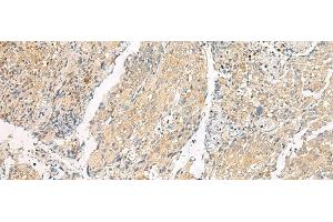 Immunohistochemistry of paraffin-embedded Human cervical cancer tissue using HEBP1 Polyclonal Antibody at dilution of 1:60(x200) (HEBP1 Antikörper)