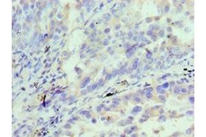 Immunohistochemistry of paraffin-embedded human lung cancer using ABIN7156833 at dilution of 1:100 (IL18RAP Antikörper  (AA 390-599))