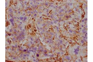 IHC image of ABIN7180354 diluted at 1:100 and staining in paraffin-embedded human liver cancer performed on a Leica BondTM system. (ACTB/POTEKP/ACTG1 Antikörper)