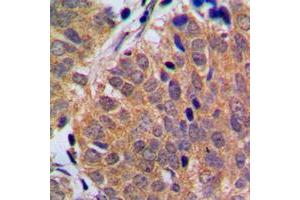 Immunohistochemical analysis of p18 INK4c staining in human breast cancer formalin fixed paraffin embedded tissue section. (CDKN2C Antikörper  (C-Term))