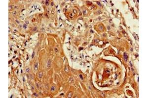 Immunohistochemistry of paraffin-embedded human cervical cancer using ABIN7169412 at dilution of 1:100 (SETD5 Antikörper  (AA 519-700))