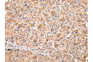 The image on the left is immunohistochemistry of paraffin-embedded Human liver cancer tissue using ABIN7192170(RERE Antibody) at dilution 1/20, on the right is treated with synthetic peptide. (RERE Antikörper)
