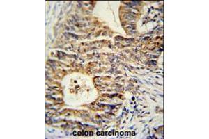 KLHL24 Antibody immunohistochemistry analysis in formalin fixed and paraffin embedded human colon carcinoma followed by peroxidase conjugation of the secondary antibody and DAB staining. (Kelch-Like 24 Antikörper  (AA 182-211))