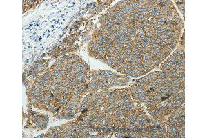 Immunohistochemistry of Human ovarian cancer using SLC16A1 Polyclonal Antibody at dilution of 1:50