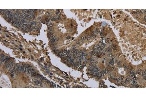 Immunohistochemistry of paraffin-embedded Human colon cancer using GSTO1 Polyclonal Antibody at dilution of 1:60 (GSTO1 Antikörper)