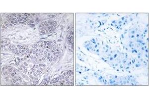 Immunohistochemistry analysis of paraffin-embedded human breast carcinoma tissue, using CEBPG Antibody. (CEBPG Antikörper  (AA 31-80))