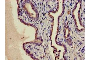 Immunohistochemistry of paraffin-embedded human prostate cancer using ABIN7169141 at dilution of 1:100 (PIM1 Antikörper  (AA 25-86))
