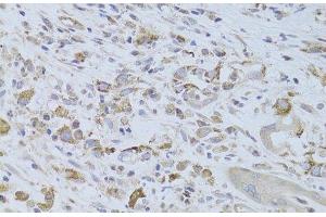 Immunohistochemistry of paraffin-embedded Human breast cancer using IGF2 Polyclonal Antibody at dilution of 1:100 (40x lens). (IGF2 Antikörper)