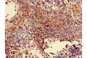 Immunohistochemistry of paraffin-embedded human cervical cancer using ABIN7143899 at dilution of 1:100