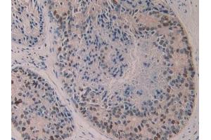 Detection of 5-LO in Human Prostate cancer Tissue using Polyclonal Antibody to 5-Lipoxygenase (5-LO)