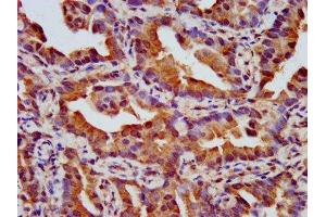 IHC image of ABIN7161158 diluted at 1:500 and staining in paraffin-embedded human lung cancer performed on a Leica BondTM system. (NPHP4 Antikörper  (AA 397-543))