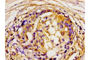 Immunohistochemistry of paraffin-embedded human breast cancer using ABIN7150072 at dilution of 1:100 (DLG2 Antikörper  (AA 310-420))