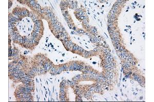 Immunohistochemical staining of paraffin-embedded Adenocarcinoma of Human colon tissue using anti-HIBCH mouse monoclonal antibody. (HIBCH Antikörper)