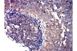 Immunohistochemical analysis of paraffin-embedded cervical cancer tissues using CD80 mouse mAb with DAB staining. (CD80 Antikörper  (AA 35-288))