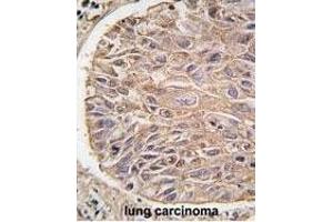 Formalin-fixed and paraffin-embedded human lung carcinoma tissue reacted with IKK beta antibody (ABIN1882097 and ABIN2842182) , which was peroxidase-conjugated to the secondary antibody, followed by DAB staining. (IKBKB Antikörper)