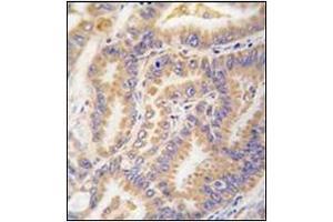 Formalin-fixed and paraffin-embedded human lung carcinoma tissue reacted with Autophagy APG12L Antibody (N-term), which was peroxidase-conjugated to the secondary antibody, followed by DAB staining. (ATG12 Antikörper  (N-Term))