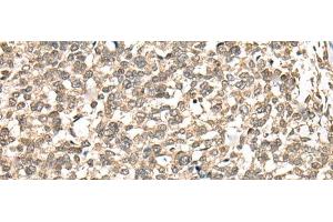 Immunohistochemistry of paraffin-embedded Human esophagus cancer tissue using PHF21A Polyclonal Antibody at dilution of 1:50(x200) (PHF21A Antikörper)
