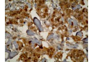 Immunohistochemistry staining of human prostate cancer tissue using CYP3A7 monoclonal antibody, clone F19 P2 H2 . (CYP3A7 Antikörper  (C-Term))