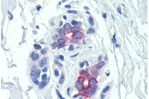 Human Breast (formalin-fixed, paraffin-embedded) stained with PRLR antibody ABIN351557 at 5 ug/ml followed by biotinylated goat anti-rabbit IgG secondary antibody ABIN481713, alkaline phosphatase-streptavidin and chromogen. (Prolactin Receptor Antikörper)