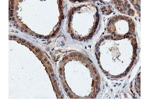 Immunohistochemical staining of paraffin-embedded Human breast tissue using anti-ILVBL mouse monoclonal antibody. (ILVBL Antikörper)