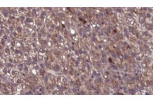 ABIN6276752 at 1/100 staining Human liver cancer tissue by IHC-P.