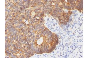 Formalin-fixed, paraffin-embedded human Colon Carcinoma stained with Cytokeratin 8 Mouse Monoclonal Antibody (C-43). (KRT8 Antikörper)