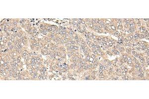 Immunohistochemistry of paraffin-embedded Human liver cancer tissue using C12orf40 Polyclonal Antibody at dilution of 1:50(x200) (C12orf40 Antikörper)