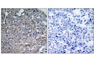 Immunohistochemical analysis of paraffin-embedded human breast carcinoma tissue using FAK (Ab-925) antibody (E021148). (FAK Antikörper)