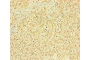 Immunohistochemistry of paraffin-embedded human ovarian cancer using ABIN7165146 at dilution of 1: 100 (BTG4 Antikörper  (AA 1-206))