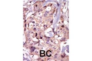 Formalin-fixed and paraffin-embedded human cancer tissue reacted with the primary antibody, which was peroxidase-conjugated to the secondary antibody, followed by AEC staining. (NR4A3 Antikörper  (AA 175-205))