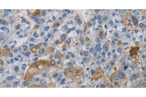 Immunohistochemistry of paraffin-embedded Human liver cancer using DNAJB4 Polyclonal Antibody at dilution of 1:50 (DNAJB4 Antikörper)
