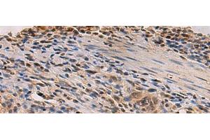 Immunohistochemistry of paraffin-embedded Human esophagus cancer tissue using PDS5B Polyclonal Antibody at dilution of 1:35(x200) (PDS5B Antikörper)