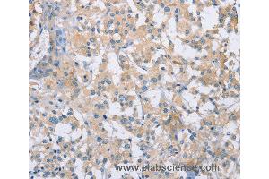 Immunohistochemistry of Human thyroid cancer using CDCP1 Polyclonal Antibody at dilution of 1:50 (CDCP1 Antikörper)