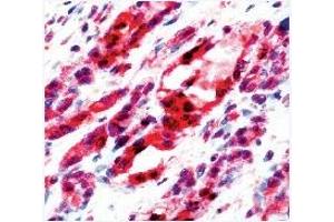 Formalin fixed paraffin embedded human angiosarcoma stained with Flk-1 antibody (VEGFR2/CD309 Antikörper  (C-Term))