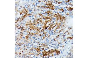 Immunohistochemistry of paraffin-embedded human lung cancer using RN antibody (ABIN7269987) at dilution of 1:100 (40x lens). (RNASE6 Antikörper  (AA 1-150))
