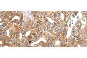 Immunohistochemistry of paraffin-embedded Human liver cancer tissue using HIPK2 Polyclonal Antibody at dilution of 1:40(x200) (HIPK2 Antikörper)