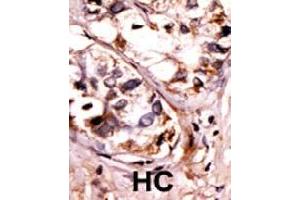 Formalin-fixed and paraffin-embedded human hepatocellular carcinoma tissue reacted with SYK (phospho Y525/526) polyclonal antibody  which was peroxidase-conjugated to the secondary antibody followed by AEC staining.