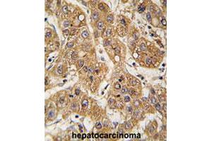 Formalin-fixed and paraffin-embedded human hepatocarcinomareacted with APOE polyclonal antibody , which was peroxidase-conjugated to the secondary antibody, followed by AEC staining. (APOE Antikörper  (C-Term))