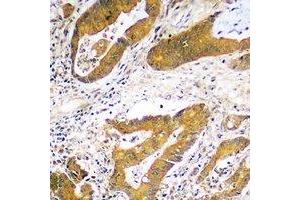 Immunohistochemical analysis of USP48 staining in human colon cancer formalin fixed paraffin embedded tissue section. (USP48 Antikörper)