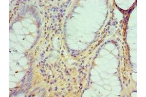 Immunohistochemistry of paraffin-embedded human colon cancer using ABIN7149566 at dilution of 1:100 (DIDO1 Antikörper  (AA 1-300))