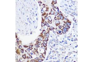 Immunohistochemistry of paraffin-embedded Human lung cancer using MTMR9 Rabbit pAb (ABIN6128253, ABIN6144163, ABIN6144164 and ABIN6217000) at dilution of 1:100 (40x lens). (MTMR9 Antikörper  (AA 1-250))