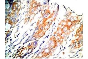 Human colon cancer tissue was stained by Rabbit Anti-GLP-1 (2-24) (Human) Antibody (GLP-1 Antikörper  (AA 2-24))